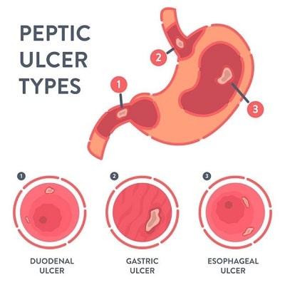 1. Stomach or esophagus ulcer-blog.easymed.ir