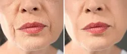 قبل و بعد مزوتراپی صورت