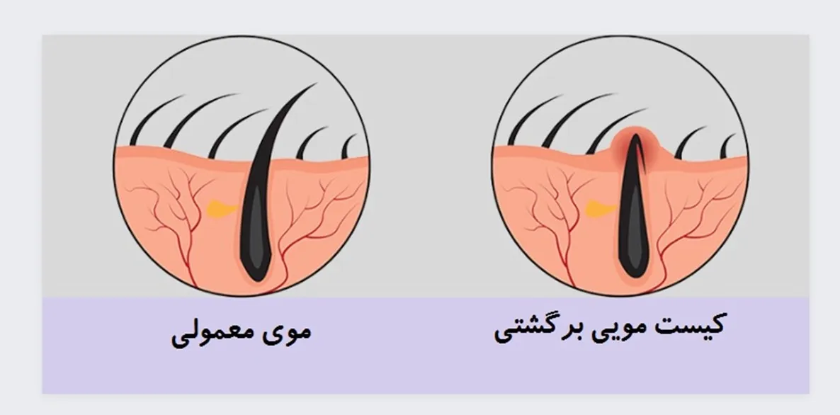 کیست پیلونیدال چیست