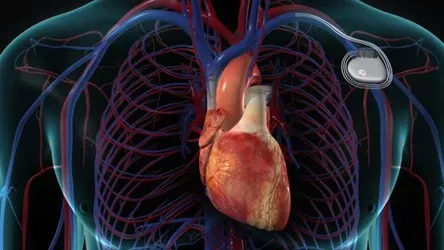 خطرات کاشت باطری قلب کدامند؟